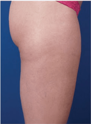 Outer thigh after Venus Freeze treatment
