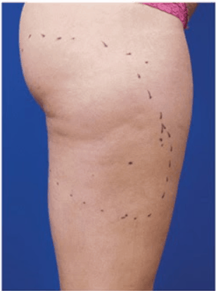 Outer thigh before Venus Freeze treatment