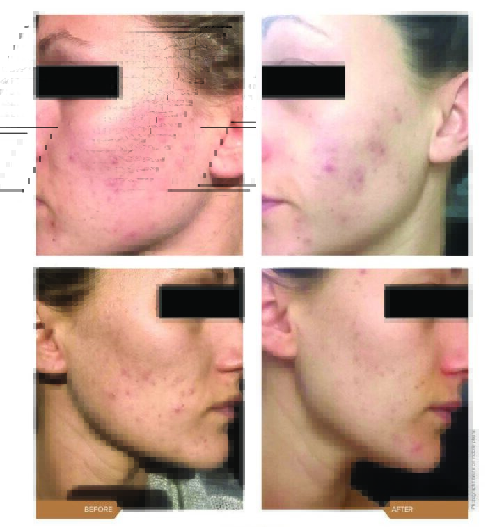 AlumierMD treatment result for acne and pigmentation