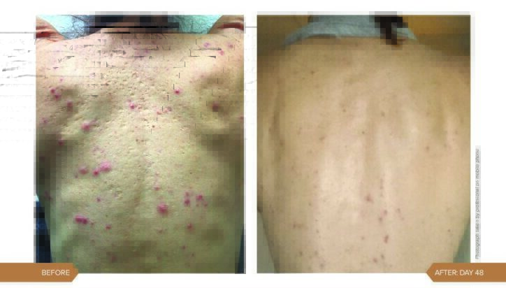 AlumierMD treatment result for acne-prone skin