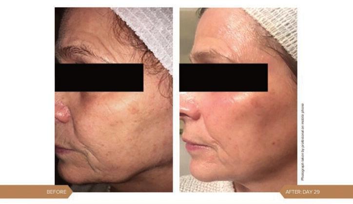 AlumierMD treatment result for ageing skin and hyperpigmentation