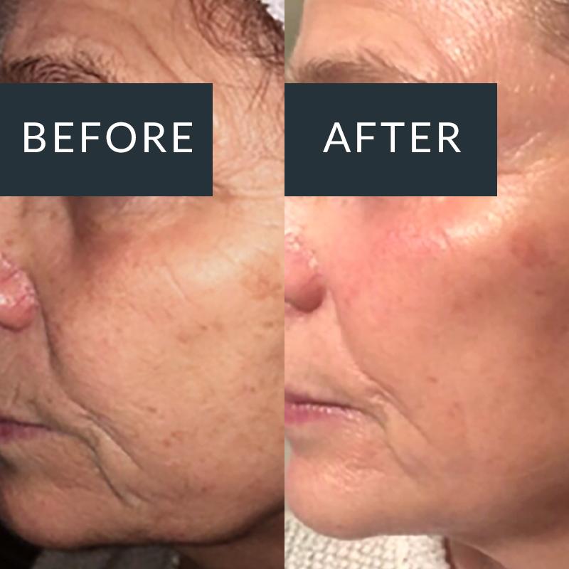 Before and after AlumierMD treatment for hyperpigmentation