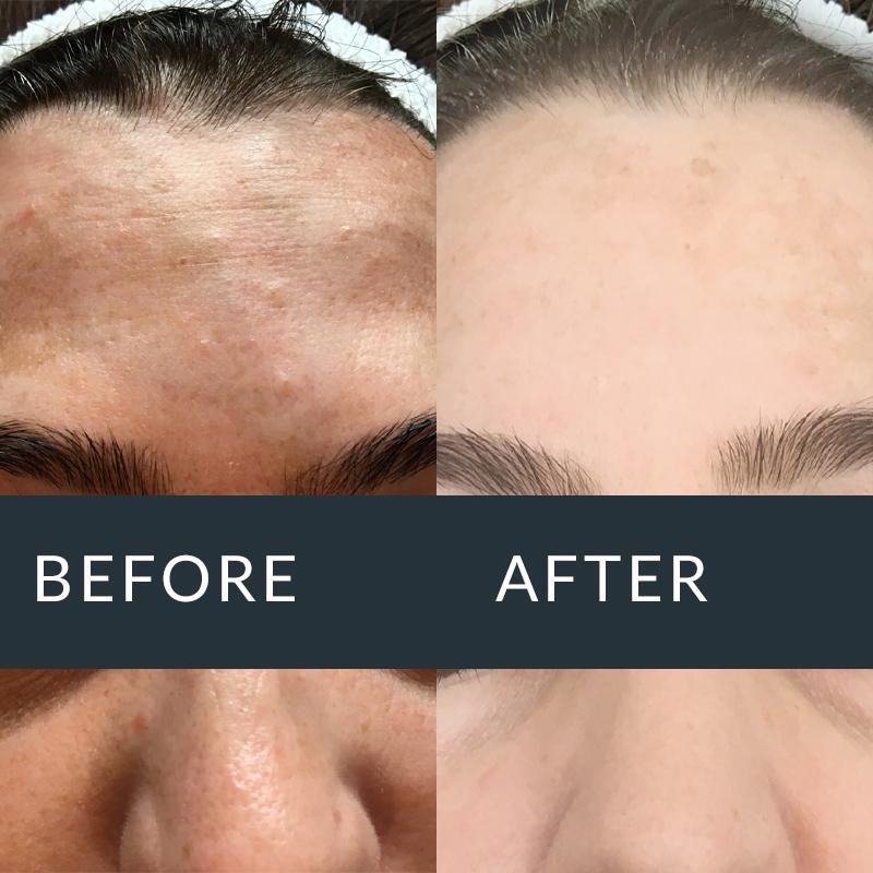 Before and after AlumierMD treatment for ageing and pigmentation