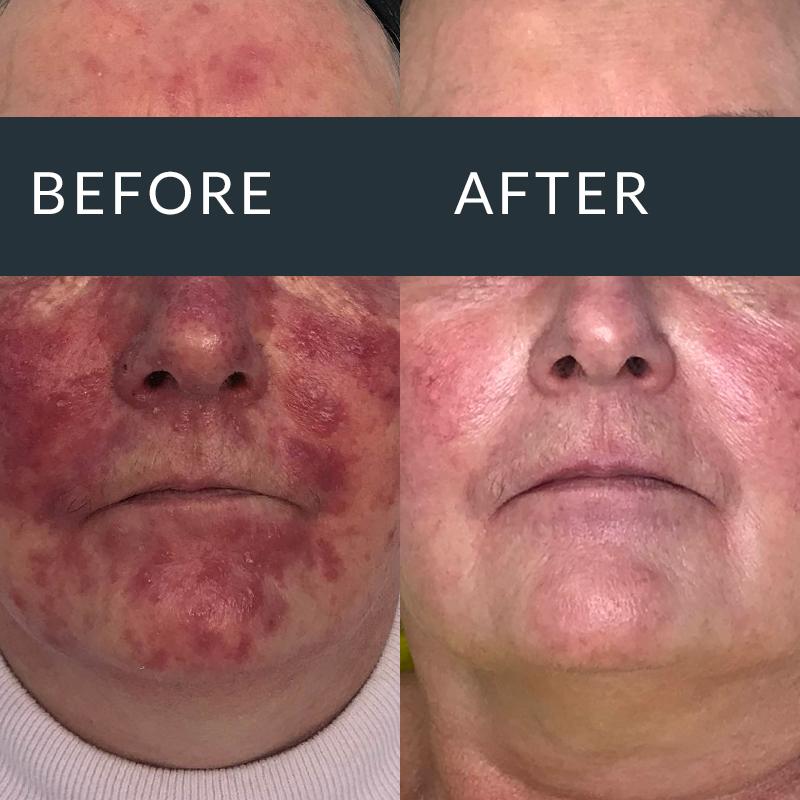 Before and after AlumierMD treatment for redness-prone skin