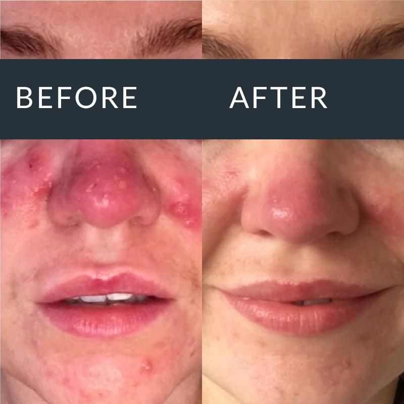 Before and after AlumierMD treatment for visible facial redness