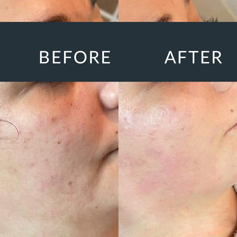Before-and-after side views of cheek skin with blemishes and dark marks
