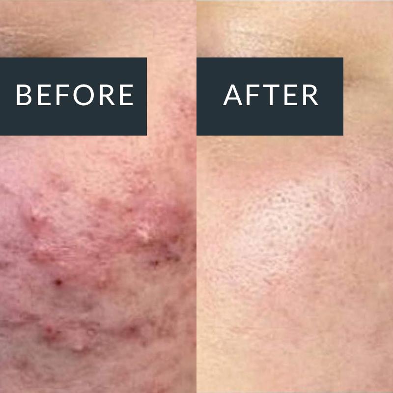 Before-and-after close-ups of inflamed spots and redness on the cheek