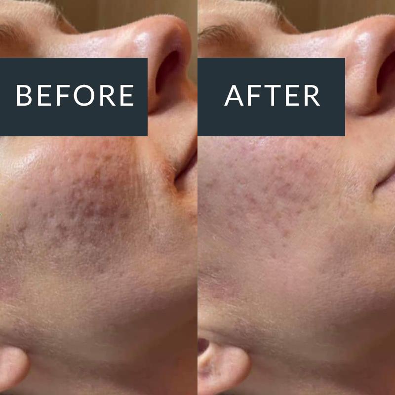 BioRePeel treatment result for acne-prone skin