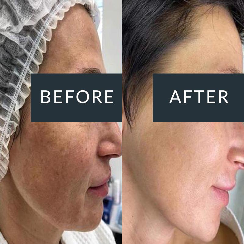 Before-and-after side views of facial pigmentation across the cheek and forehead