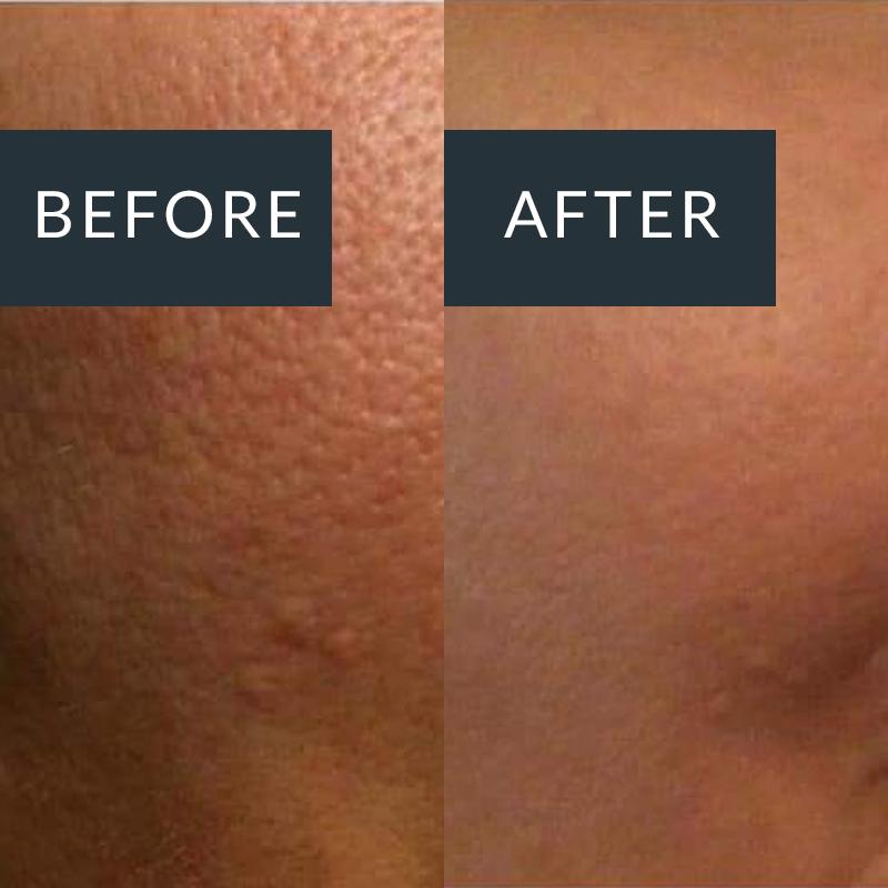BioRePeel treatment result for enlarged pores and acne scarring