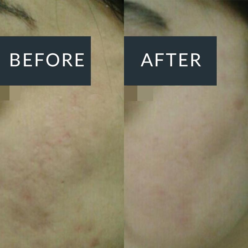 Before and after microneedling treatment for acne-related scarring