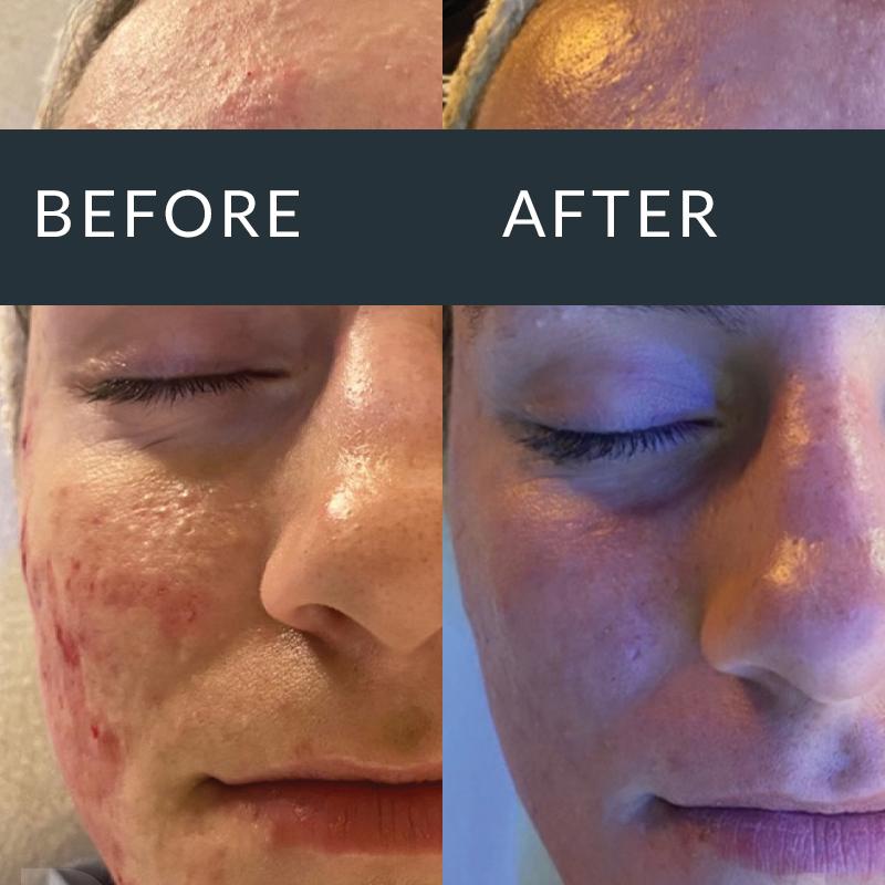 Dermapen microneedling result for post-acne scarring