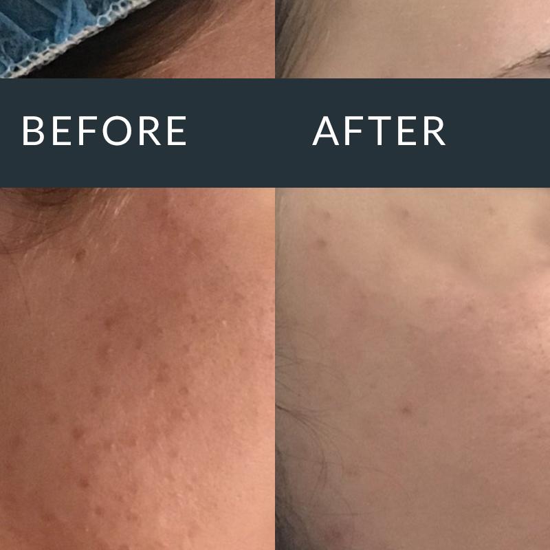 Before-and-after close-ups of cheek texture and small acne marks