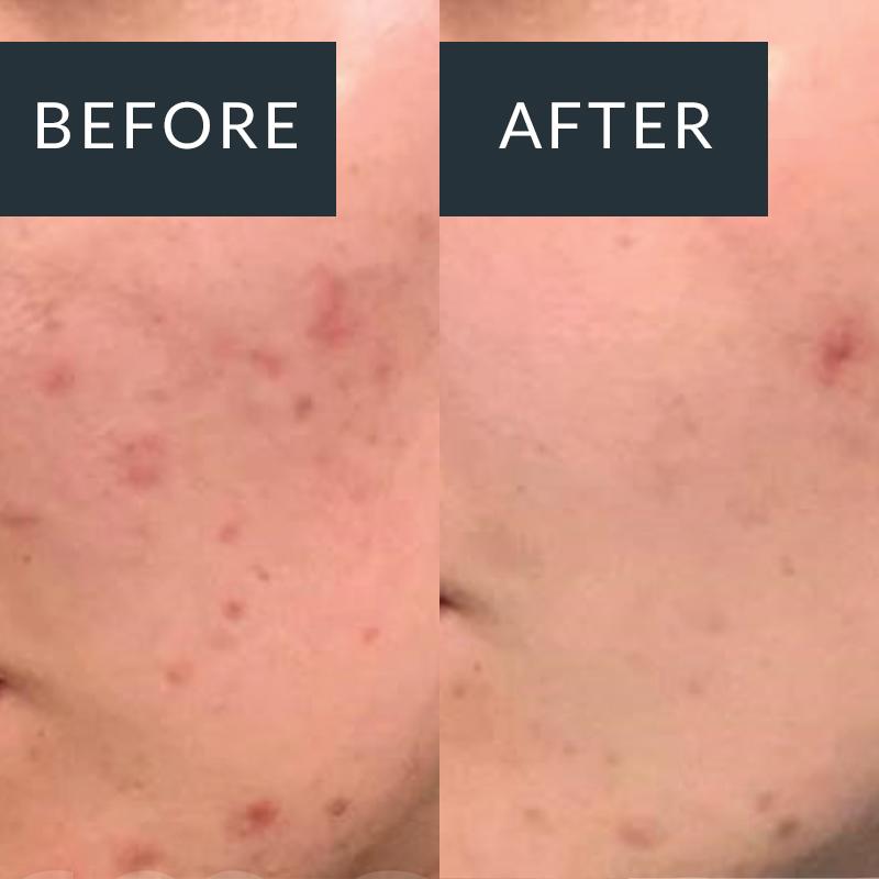 Before-and-after cheek photographs showing blemishes and discolouration