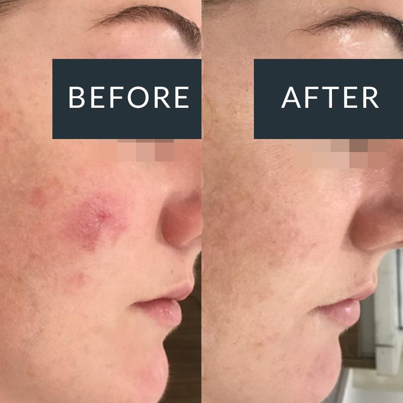 Dermapen microneedling result for acne-prone skin and uneven texture