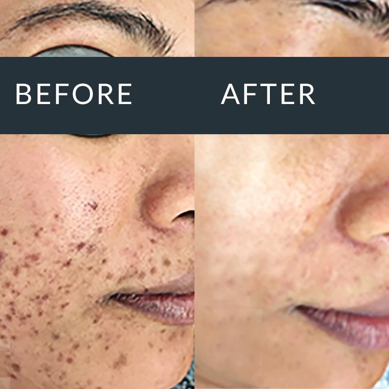 Before and after professional microneedling for acne and post-blemish marks