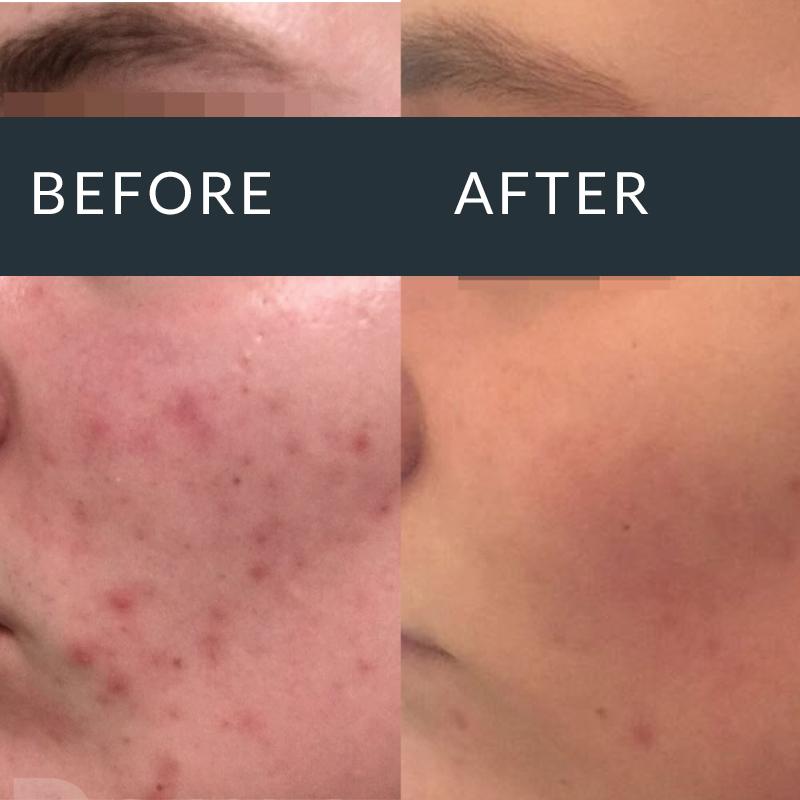 Microneedling treatment result for acne-prone skin