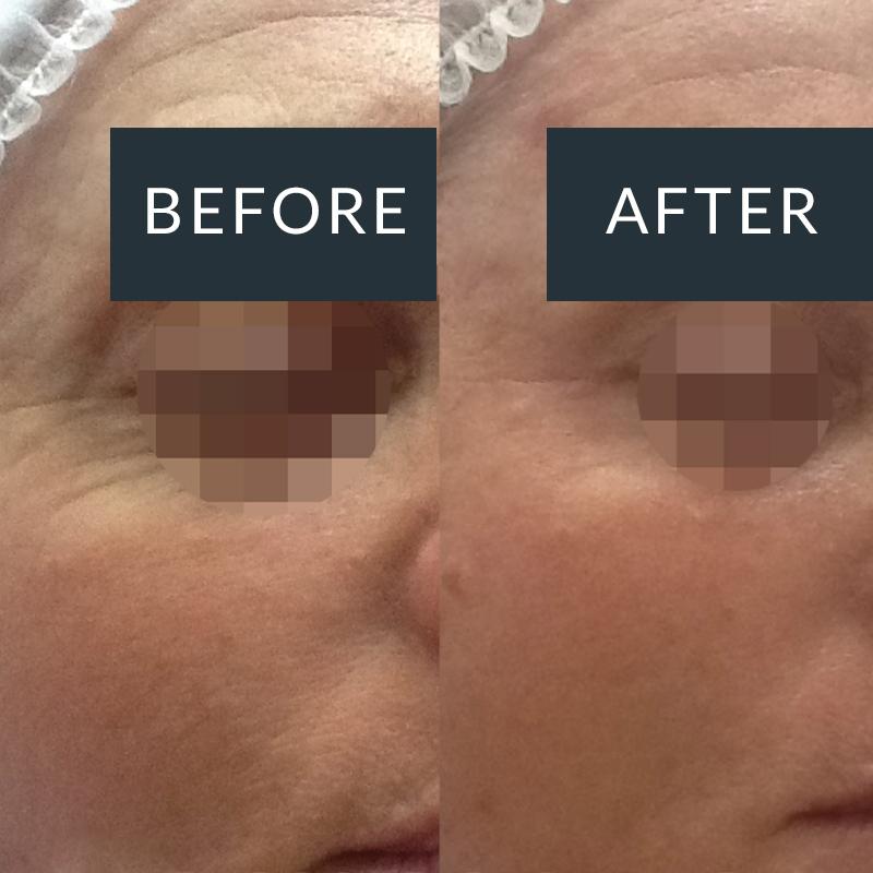 Before and after Dermapen microneedling for visible signs of ageing