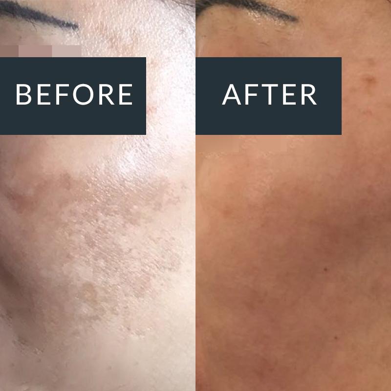 Before-and-after close-ups of brown pigmentation patches on the cheek