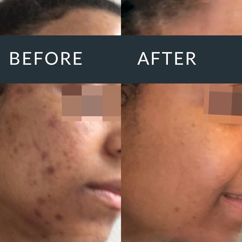 Before-and-after facial photographs showing dark cheek marks, with the eyes obscured