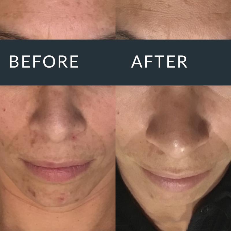 Before-and-after front views of uneven pigmentation on the cheeks and chin