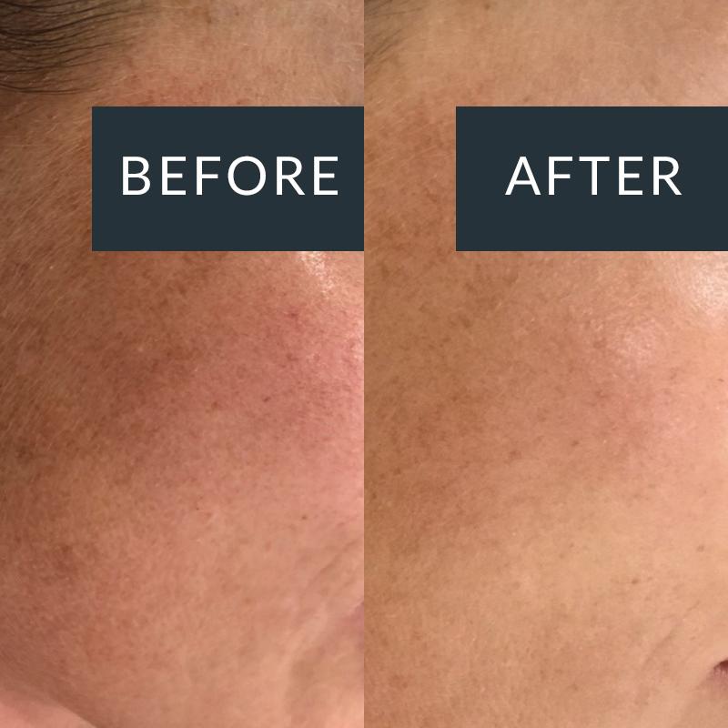 Before-and-after close-ups of cheek pigmentation and fine lines