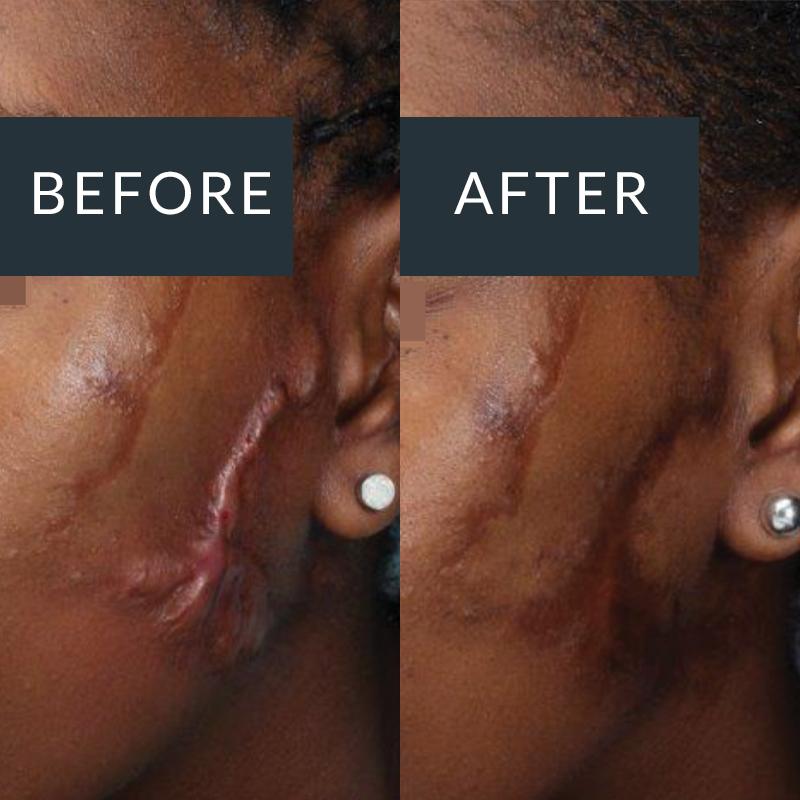 Before and after Dermapen microneedling for acne scarring