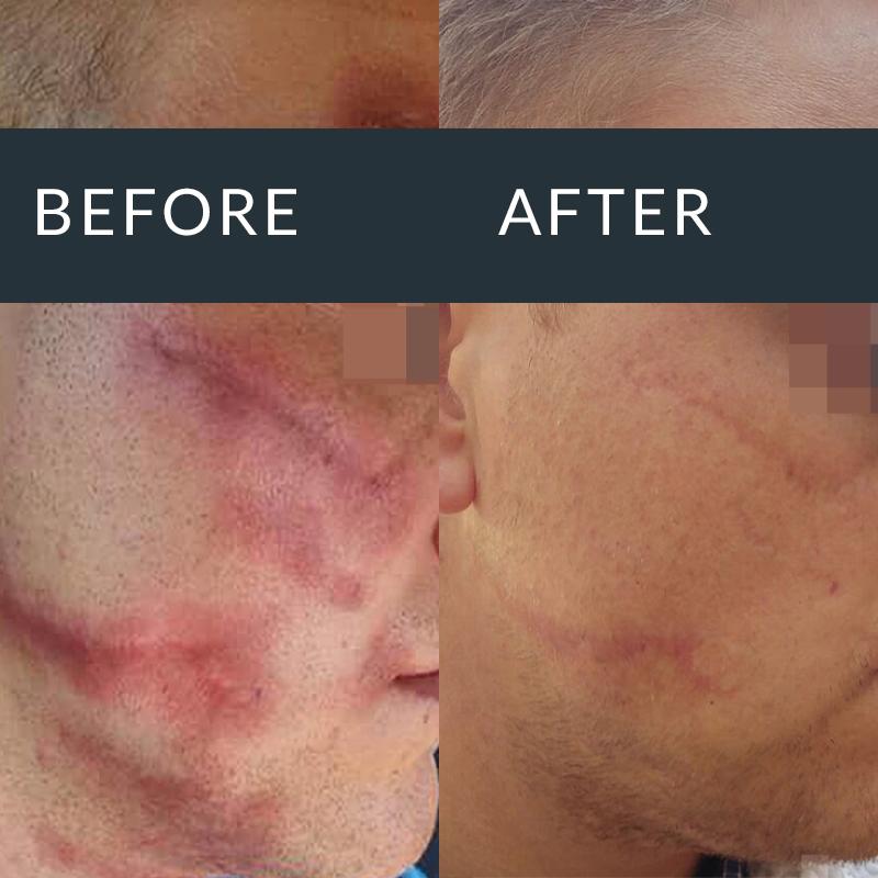 Microneedling treatment result for indented acne scars and uneven texture
