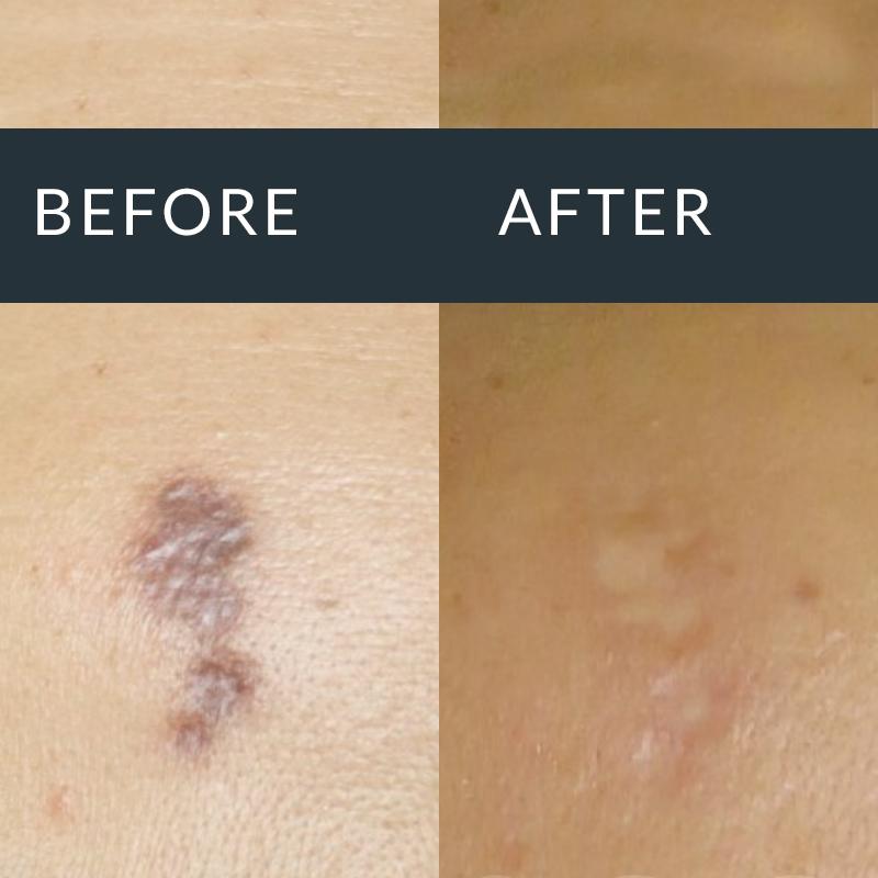 Before-and-after close-ups of a dark, uneven skin scar