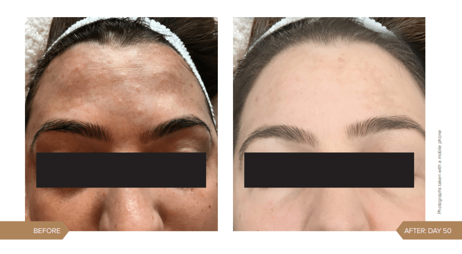 AlumierMD treatment result for ageing skin and pigmentation