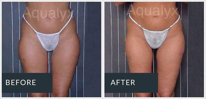 Before and after Aqualyx treatment around the hips and upper thighs