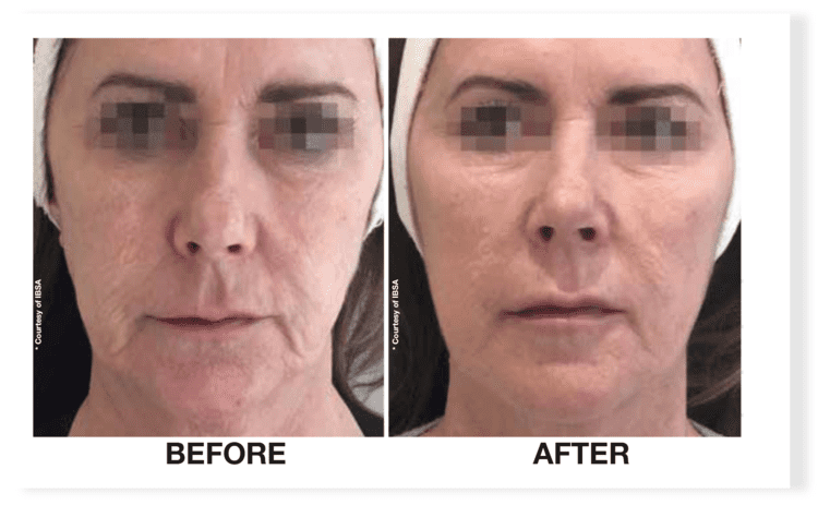 Before and after Profhilo treatment showing improved facial skin quality