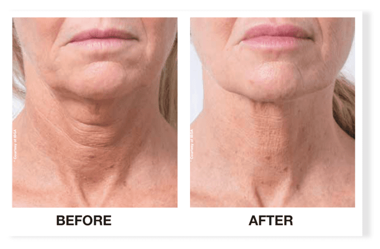 Before and after Profhilo treatment for facial skin hydration and texture
