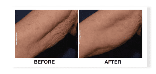 Profhilo before and after skin rejuvenation result