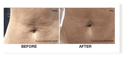 Before and after Profhilo treatment showing improvement in skin texture
