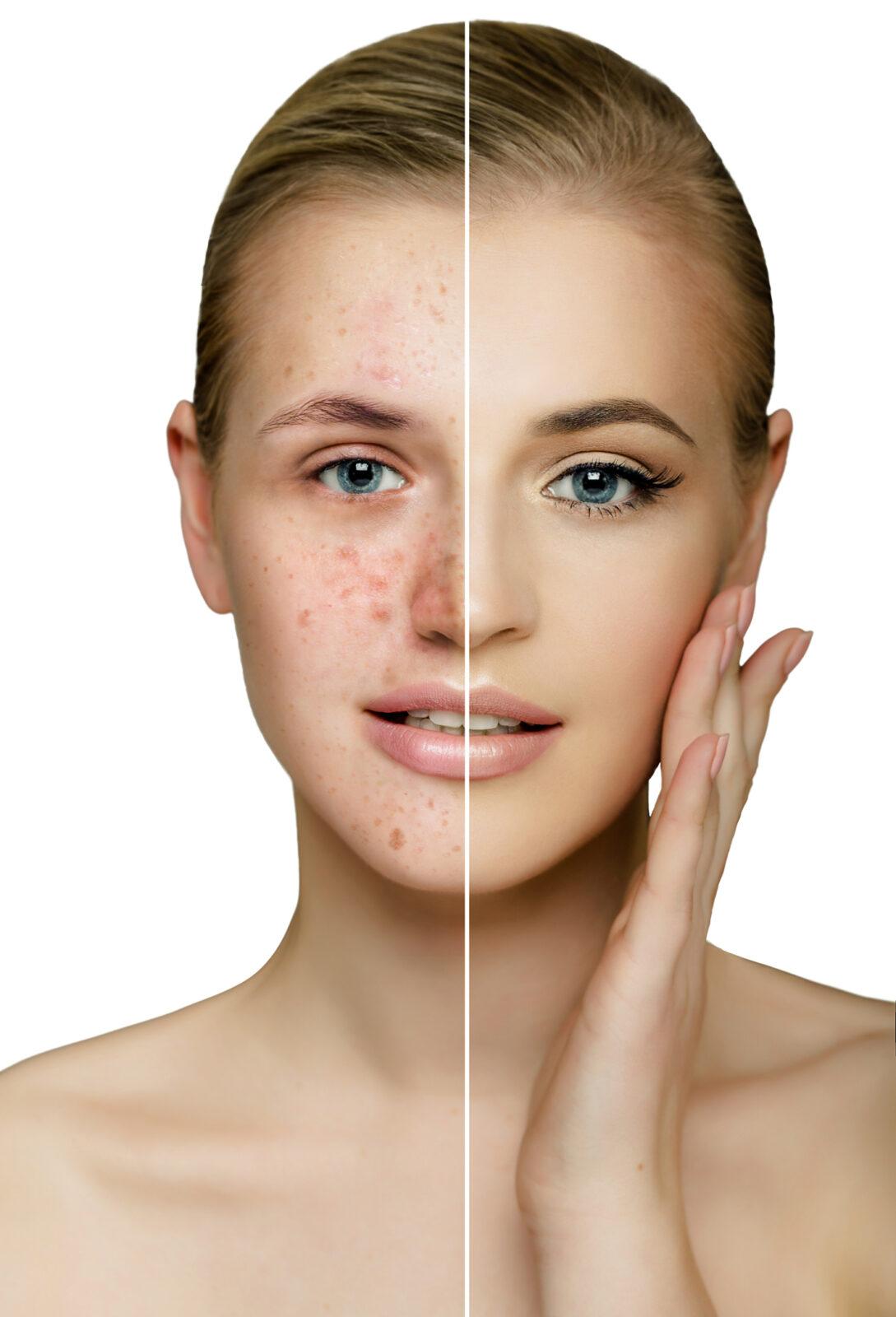 Acne and acne scarring skin treatment information