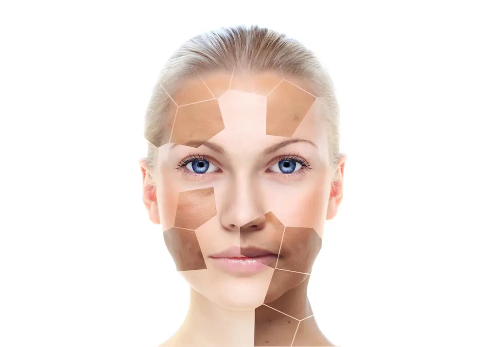 Hyperpigmentation and melasma skin treatment information