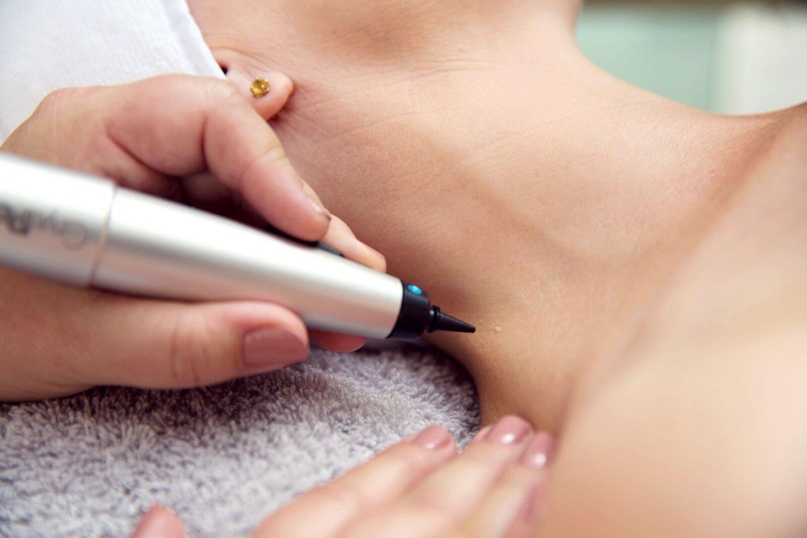 CryoPen treatment at Derma Aesthetics Clinic Brentwood