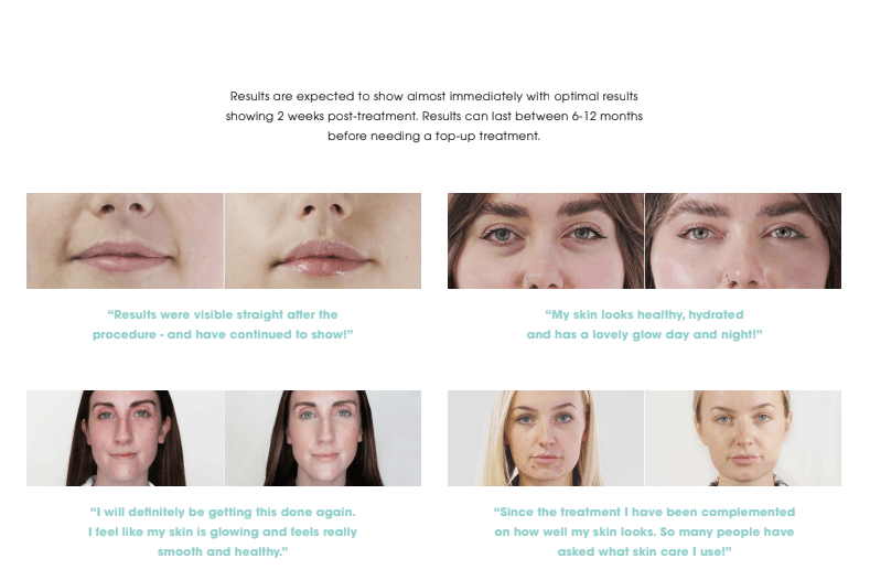 Seventy Hyal facial before-and-after photo comparisons