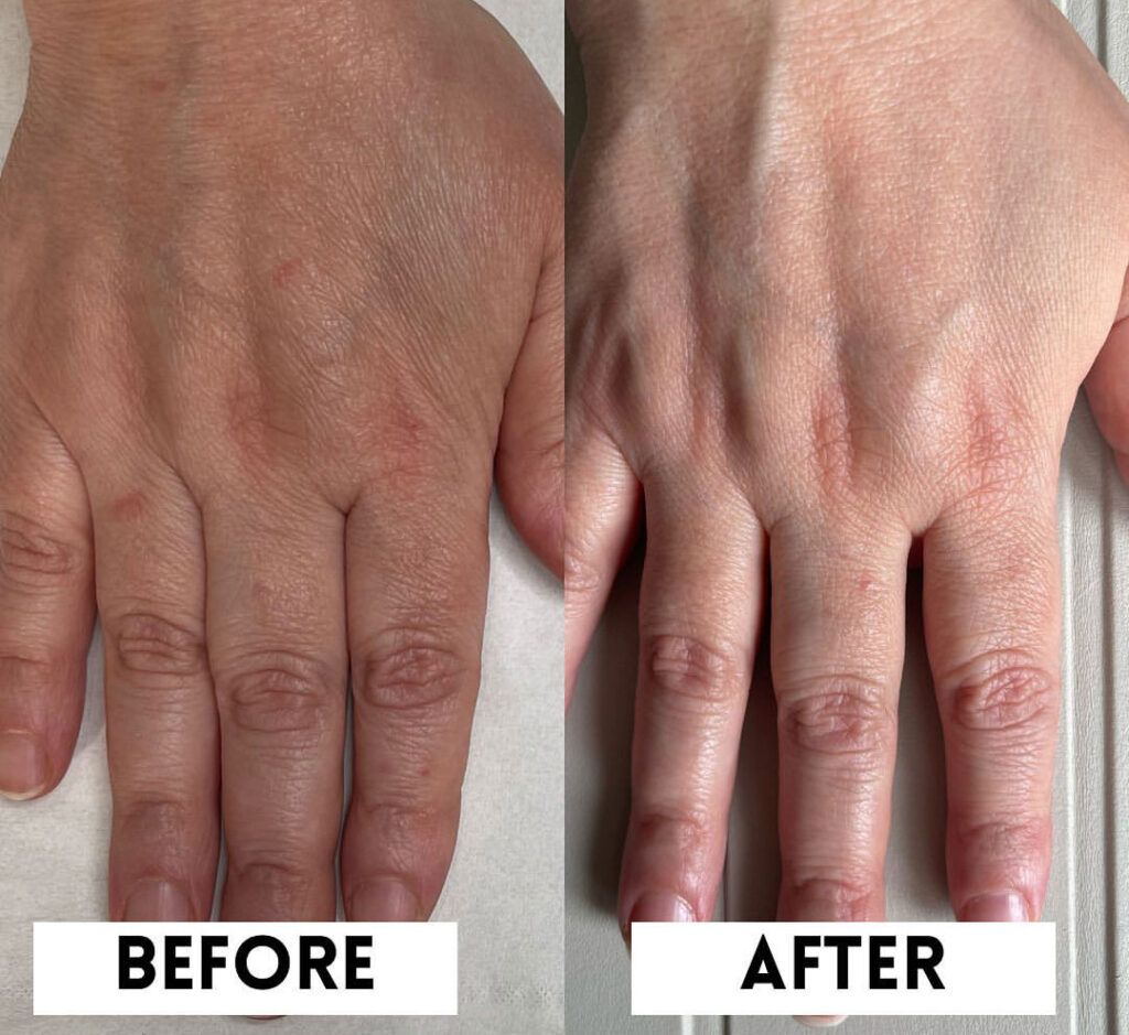 Back of a hand before and after Seventy Hyal treatment