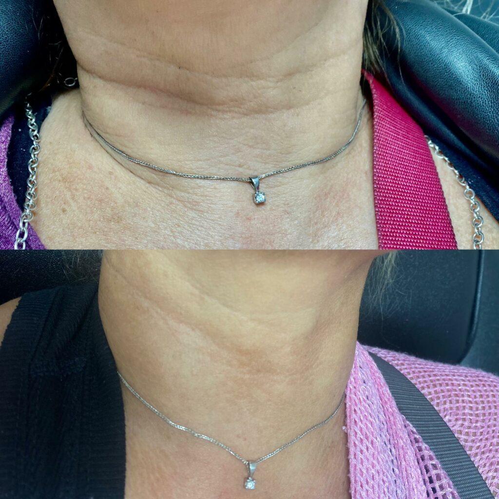 Two comparison photographs of neck skin texture and horizontal lines