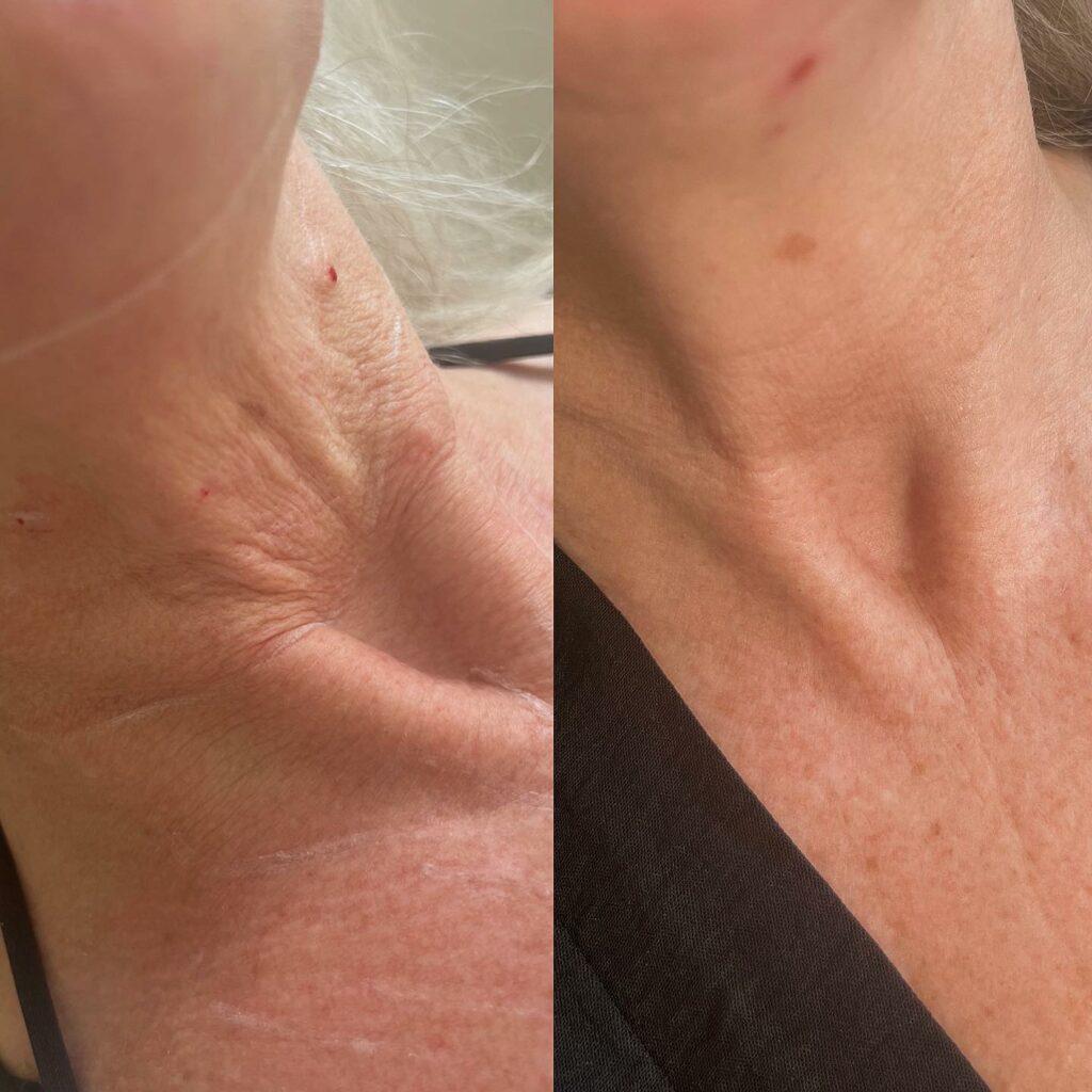 Side of the neck and upper chest before and after Seventy Hyal treatment